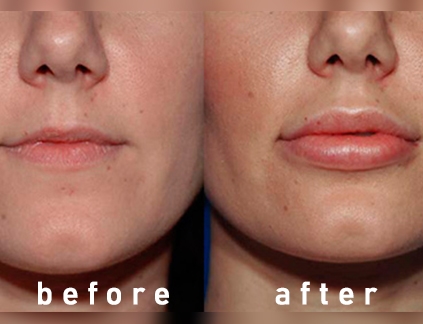 تصاویر قبل و بعد از تزریق ژل